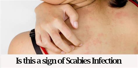 home remedies for scabies