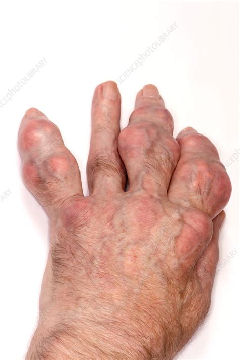 Gout in the fingers - Stock Image - C014/2457 - Science Photo Library