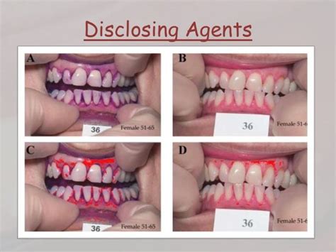 Dental plaque formation