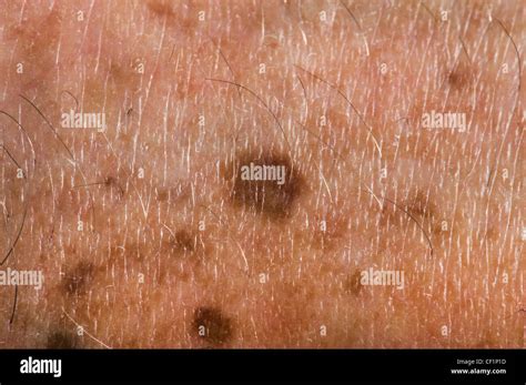 Brown Spots On Skin Cancer