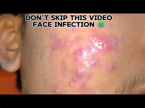 blackheads removal 2024 | sac dep spa blackheads removal 2024 | skin ...