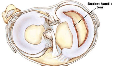 What is a Bucket Handle Meniscus Tear – New Life Ticket