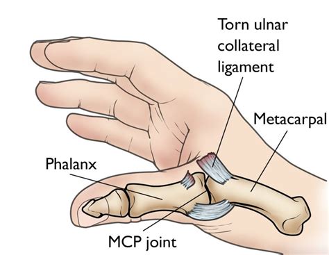 Thumb Sprain: Symptoms, Causes & Treatment Plan | Longevity