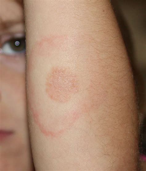 File:Lyme Disease Rash on 5 year old.jpg - Wikimedia Commons