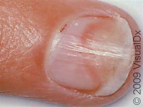 Onycholysis: Causes, Symptoms, and Treatment - Skinsight