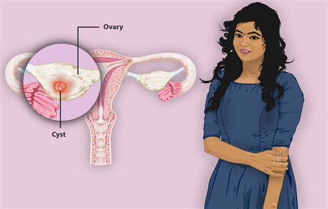 Ovarian cyst and its Homeopathic Treatment | Kidney Failed