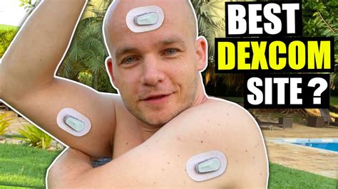 7 Best Sites for Dexcom G6 Sensor Placement - YouTube