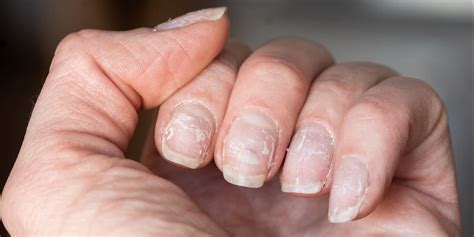 Here’s Why Your Nails Keep Peeling and Flaking—and What to Do About It