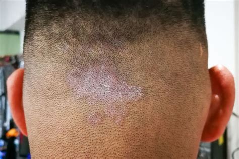 Scalp Ringworm - Tinea Capitis Symptoms, Treatment and Cure – Traya