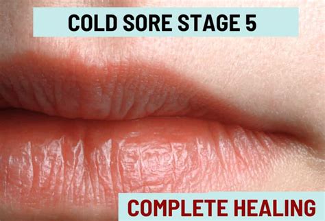 Cold Sore Stages, with Pictures