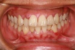 Gingival Disease Article - Dental Hygiene