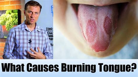 In this video, I discuss what causes a burning tongue. | Healthy tongue, Burning tongue, Diet doctor