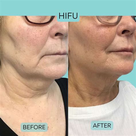 HIFU Before After Results Vie Aesthetics, 45% OFF