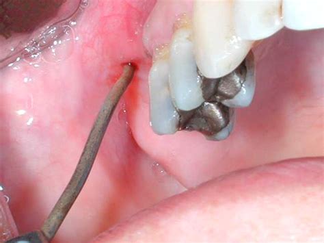 Endoscopic Surgical Treatment of Chronic Maxillary Sinusitis of Dental ...