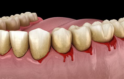 Bleeding Gums | Arkansas Periodontal and Implant Associates