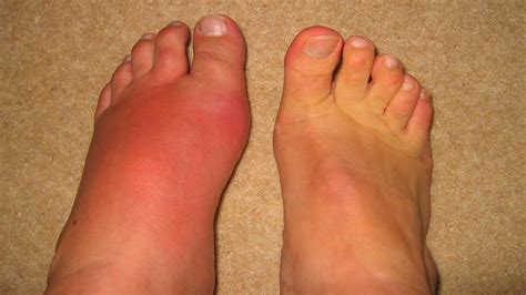 Gout | Gout causes | How to treat gout | Home Remedies for Gout - YouTube