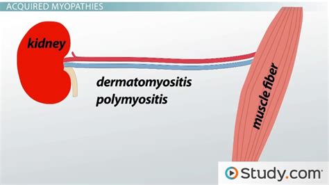 What is Myopathy? - Definition, Causes & Symptoms - Lesson | Study.com