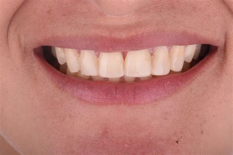 Veneers Before and After - Dr Orlando Rodriguez
