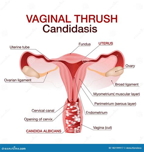 Vulvovaginal Candidiasis or Vaginal Yeast Infection.Vector Illustration Stock Vector ...