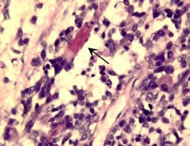 Pathology - Rhabdomyosarcoma: Overview, Histology, Presentation and Evaluation