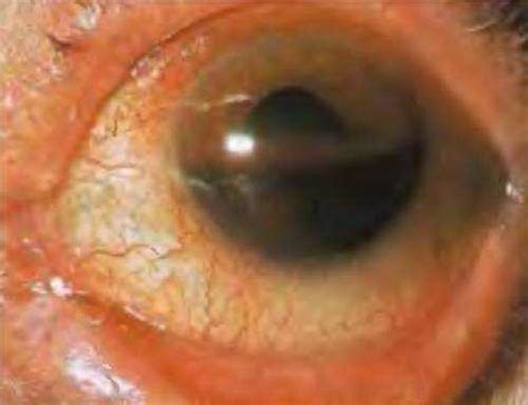 Hyphema: Symptoms, Causes and Treatment | EYExan.com