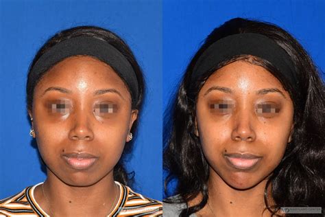 Plastic Surgery Before and After Pictures Baltimore, Towson, MD