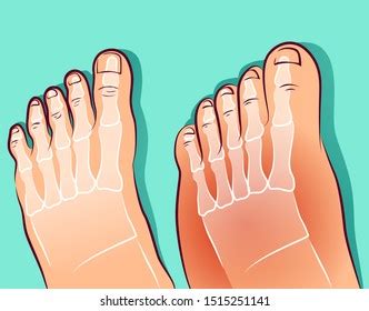 Swollen Feet Beforeafter Vector Illustration Stock Vector (Royalty Free) 1515251141 | Shutterstock