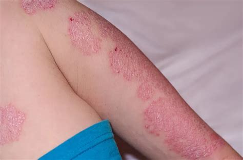 Kenali Psoriasis Vulgaris, Penyakit yang Bisa Terjadi pada Ibu Hamil