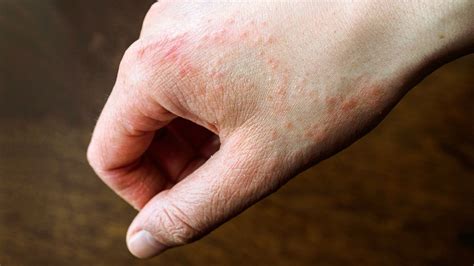 What causes a rash on your hands and feet
