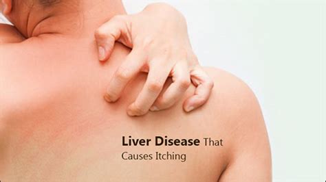 Liver Disease And Itching In The Skin