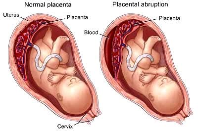 SOLUSIO PLASENTA (PLASENTA LEPAS SEBELUM WAKTUNYA)