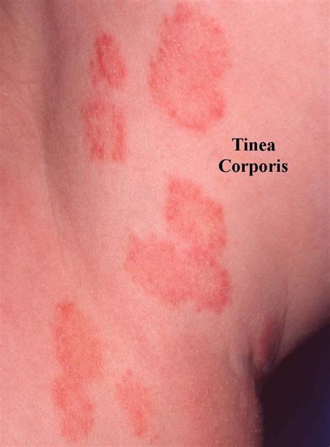 Ringworm, tinea, causes, signs, symptoms, diagnosis & treatment