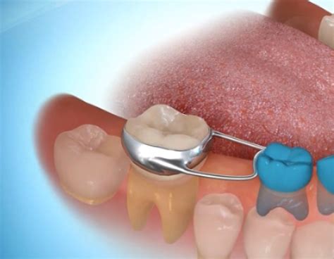 SPACE MAINTAINER - WORLD CLASS DENTAL CLINIC, PUNE