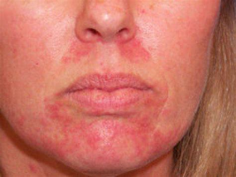 Facial Rash: Causes and Treatment | New Health Advisor