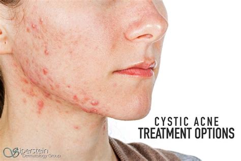 Cystic Acne: Dermatologists Explain Causes And Tips To, 49% OFF