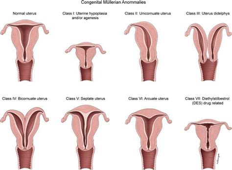 Different types of uterine abnormalities Midwifery Student, Student Midwife, Bicornuate Uterus ...