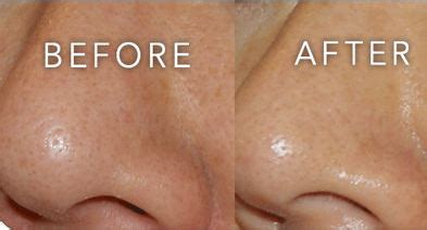 How to Clear Pores on Nose, Face, Clear Clogged Pores at Home Naturally