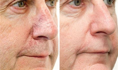 Laser for broken capillaries on face - Cosmetic Surgery Tips