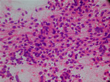 Figure 5. FNAC from Thyroid nodule showing cellular histology of Medullary Carcinoma Thyroid : A ...