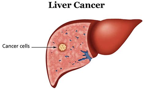 Cancer de ficat - tratament - e-medicina.md