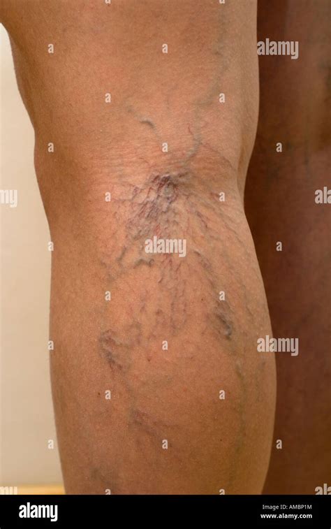 Thread veins of legs Stock Photo - Alamy