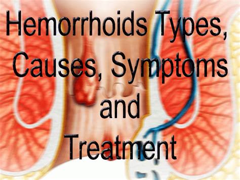 hemorrhoids causes symptoms treatment internal and external hemorrhoid