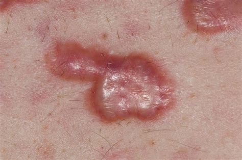 Keloid Scars In Acne Vulgaris Photograph by Dr P. Marazzi/science Photo ...