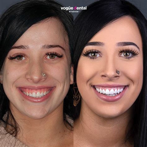 Picasso Porcelain Veneers Before and After - Rachael - Vogue Dental Studios