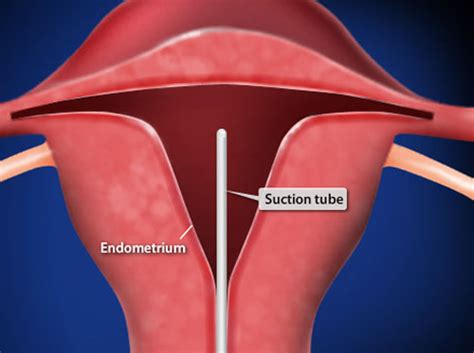 Video - Endometrial Biopsy - HealthClips Online