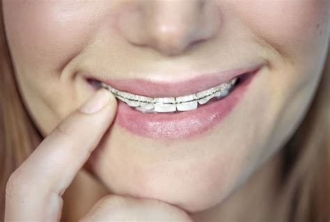 Clear Braces - Embrace Orthodontics