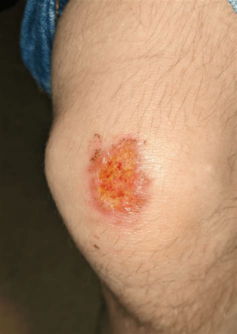 Next steps for healing an infected scrape? : r/woundcare