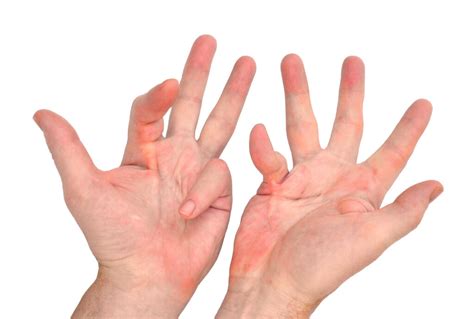 Dupuytren's Contracture Exercises - Bút Chì Xanh