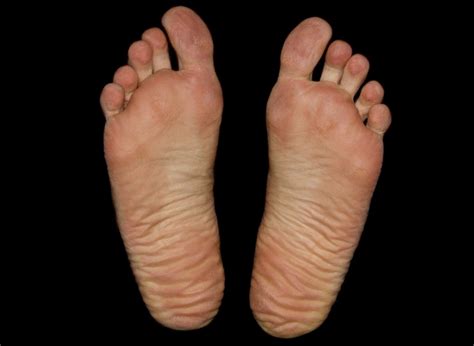 The causes of dry skin on your feet and how to treat it - Chiropractor Melville | Experienced ...