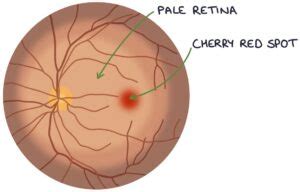 Central Retinal Artery Occlusion – Zero To Finals